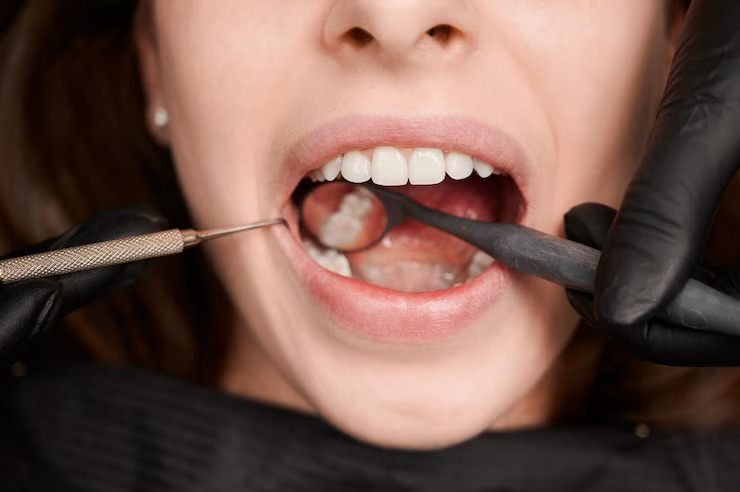 What Causes Cavities and How to Prevent Them?