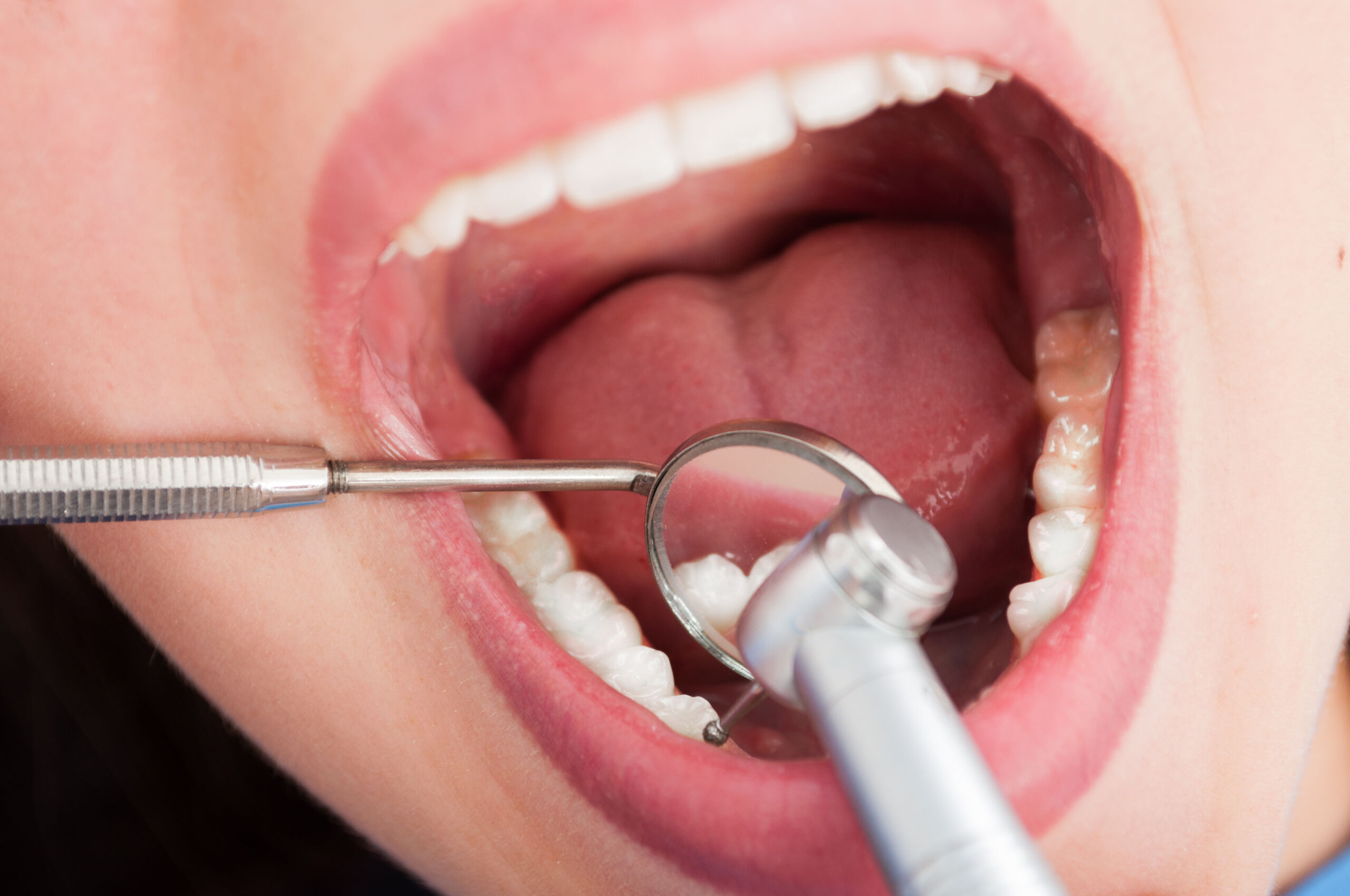 Root canal therapy in Georgetown