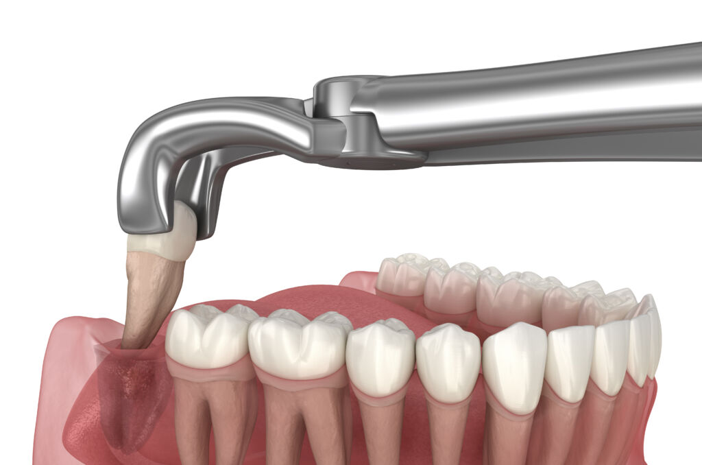 Wisdom Tooth Extraction