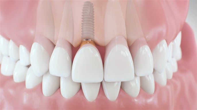 All-on-4 dental implant diagram showing four implants supporting a full arch