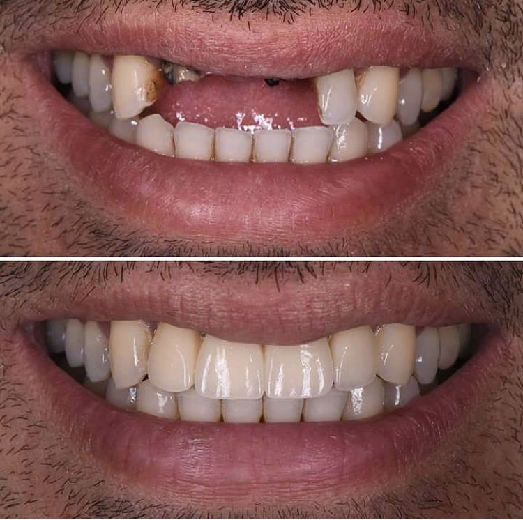 Before and after multiple implants